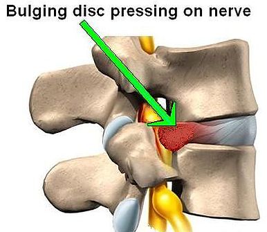 bulging disc