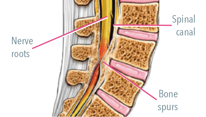 Lumbar Spinal Stenosis graphic